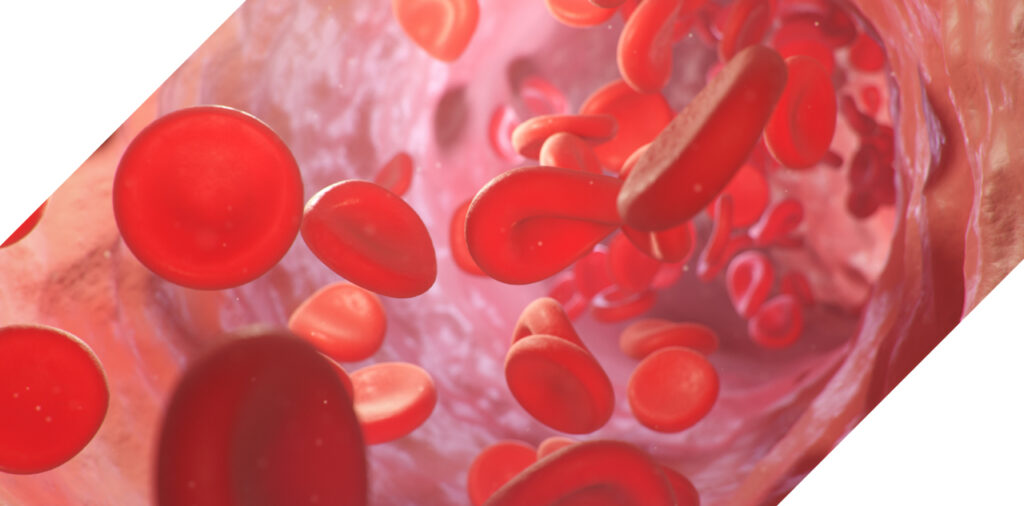 Peripheral Artery Disease (PAD)