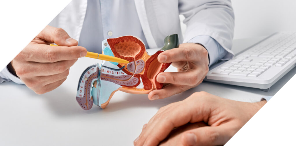 enlarged prostate (BPH) prostate artery embolization