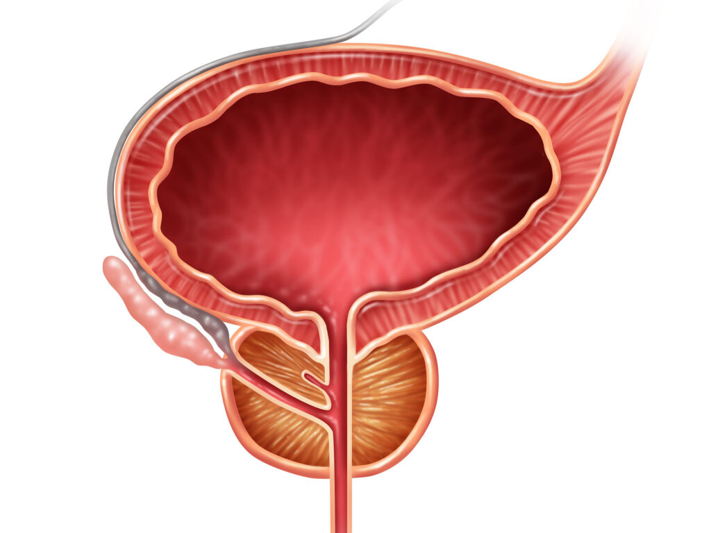 PAE Prostate Illustration