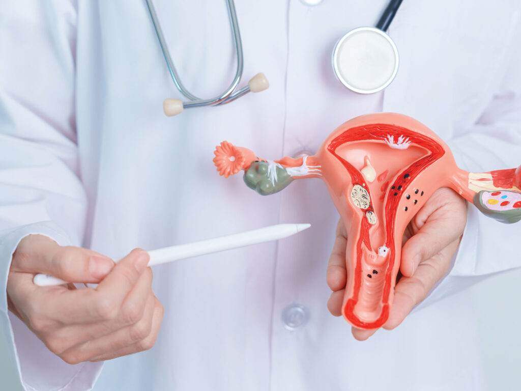 Differences Between UFE and Hysterectomy Model